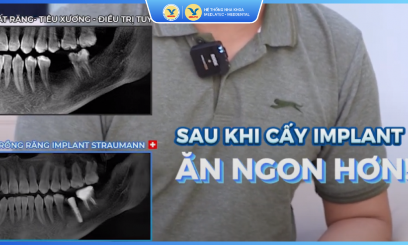 Phản hồi của khách hàng Đỗ Mạnh Thắng về dịch vụ Điều trị tủy và trồng răng Implant tại MedDental