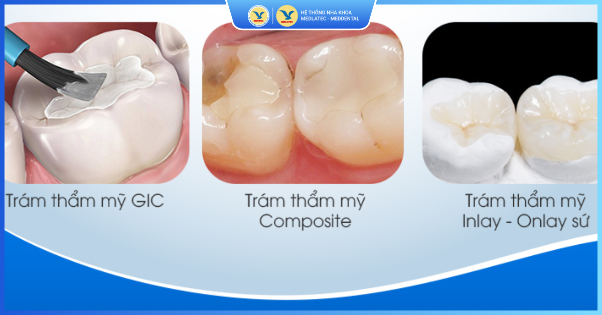 Vật liệu trám răng GIC - Hàn răng