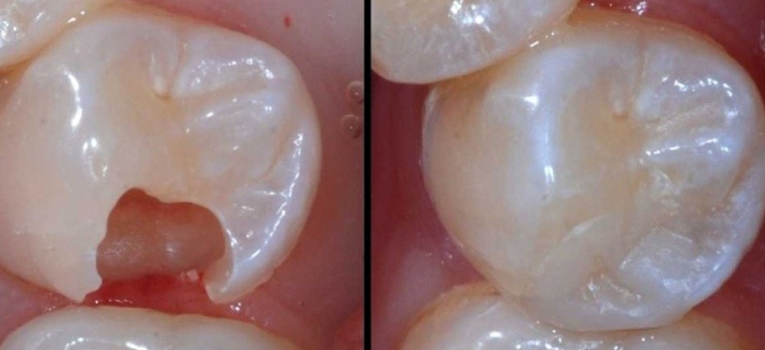 Trám răng hàm bị vỡ Trám răng hàm bị vỡ
