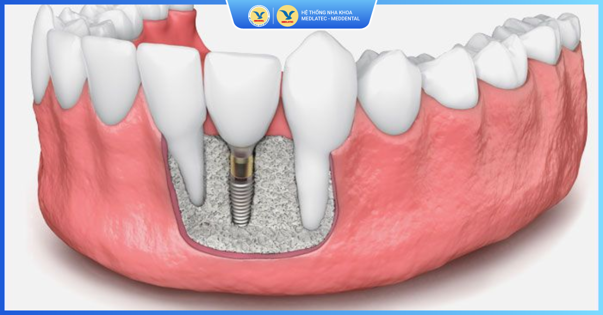 Trụ răng bị đào thải - Ghép xương răng