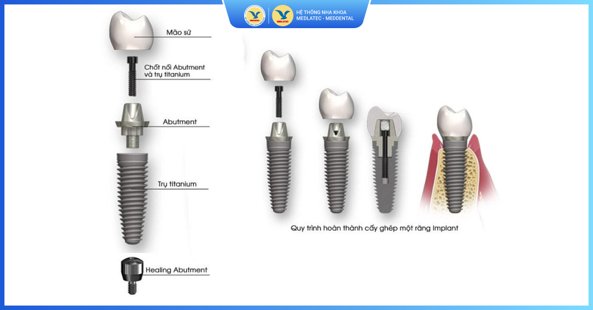 Thân răng - Các loại trụ Implant