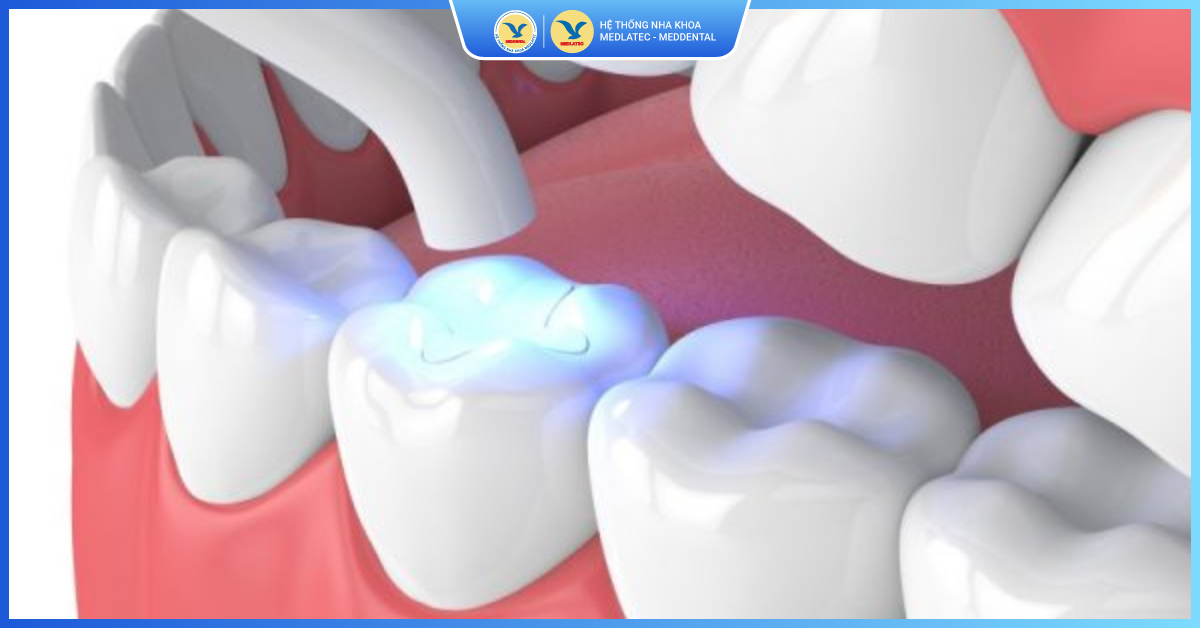 Những lưu ý khi lựa chọn chất hàn răng - Hàn răng