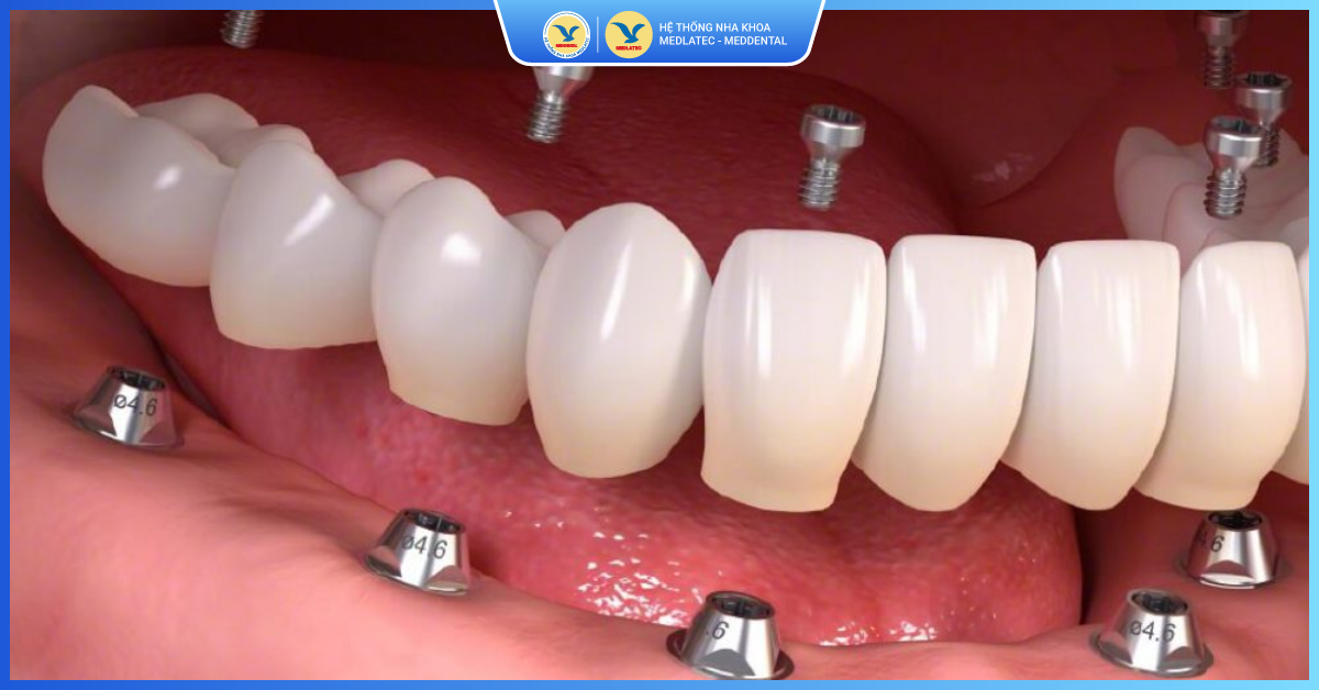 Trồng răng Implant toàn hàm - Trồng răng nguyên hàm