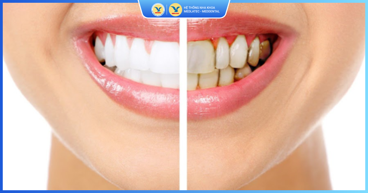 Sở hữu hàm răng đẹp, nụ cười tự tin - Răng sứ toàn hàm