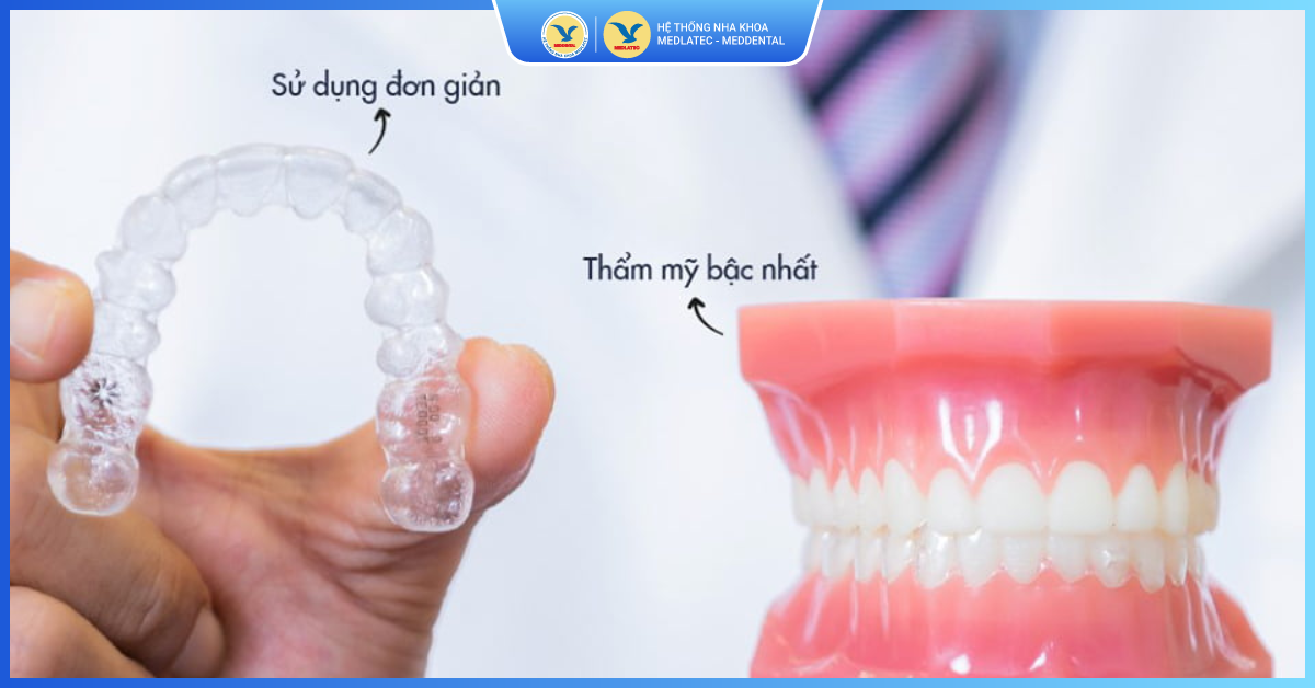 Tìm hiểu kỹ thuật niềng răng trong suốt Invisalign - Niềng răng trong suốt Invisalign