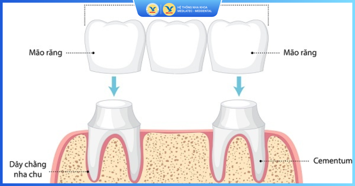Chất liệu mão sứ - Cầu răng sứ