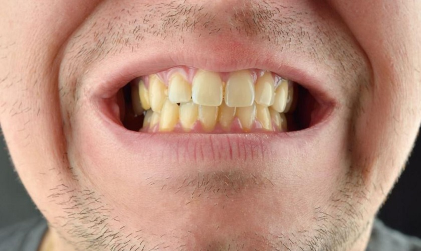 Răng bị ố vàng do vệ sinh răng miệng sai cách