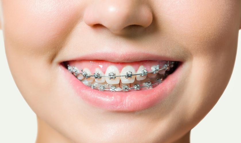Niềng răng là giải pháp tối ưu giúp khắc phục tình trạng lệch khớp cắn