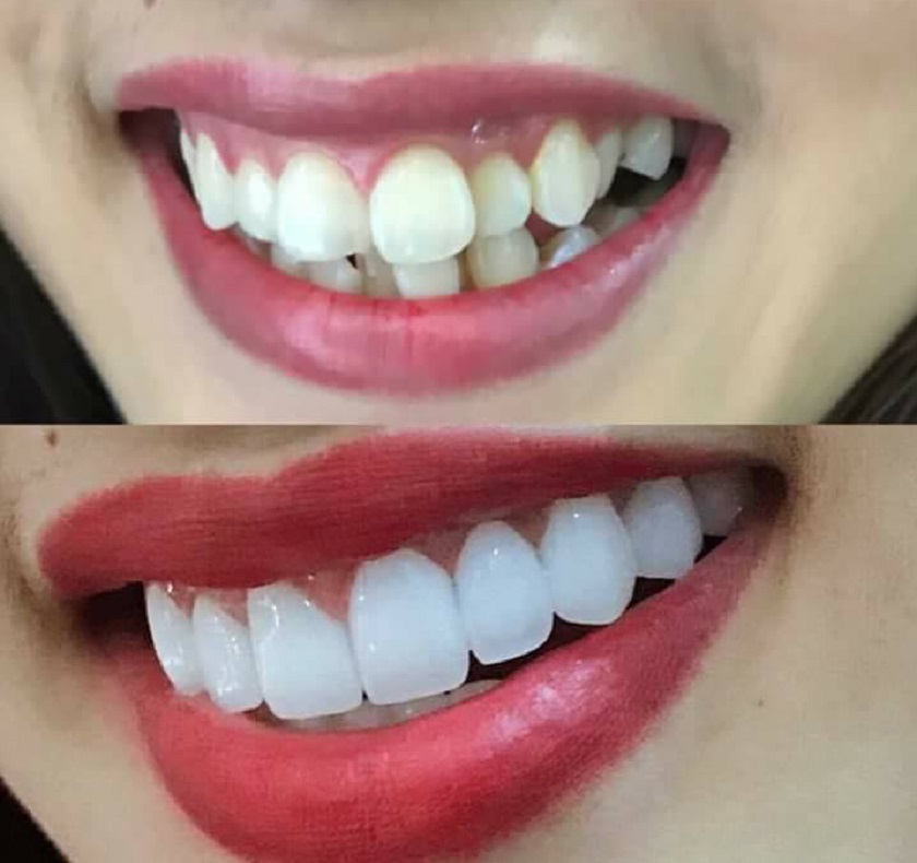 Điều trị răng khấp khểnh bằng biện pháp bọc răng sứ Điều trị răng khấp khểnh bằng biện pháp bọc răng sứ