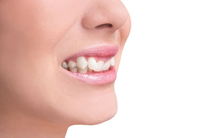 Phương pháp bọc sứ răng khểnh