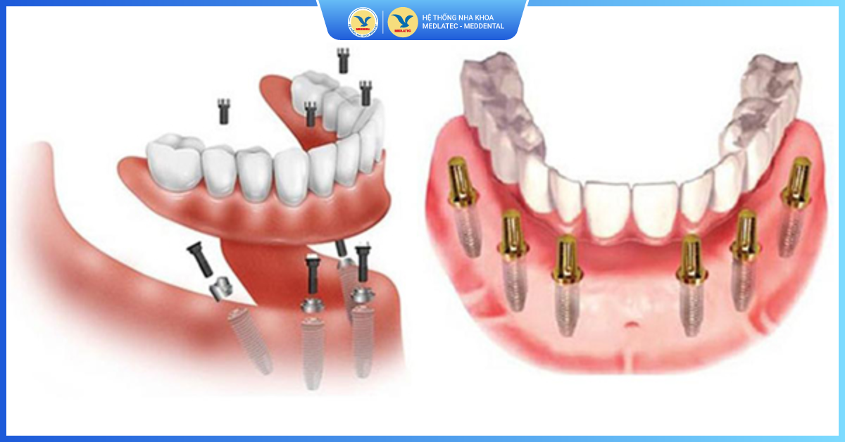 Cấy ghép Implant All On là gì? Trường hợp nào cần sử dụng? - Kỹ thuật Implant All On