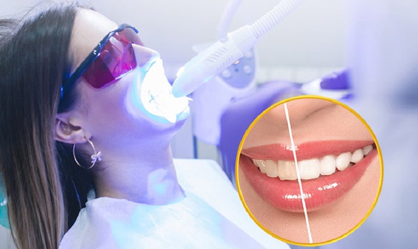 Công nghệ tẩy trắng răng hiện đại Laser Whitening