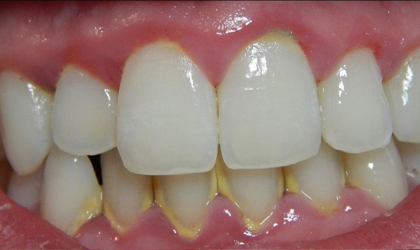 Bột trắng răng Eucryl có thể giúp loại bỏ mảng bám trên răng Bột trắng răng Eucryl có thể giúp loại bỏ mảng bám trên răng