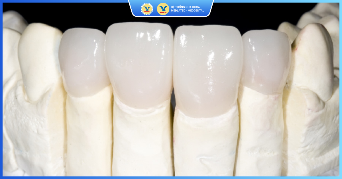 Răng sứ Cercon - Răng toàn sứ