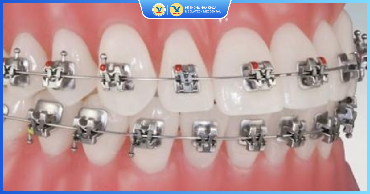 Niềng răng mắc cài tự động - Niềng răng thẩm mỹ