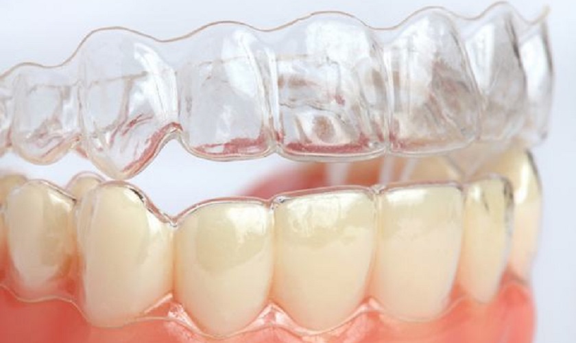 Hàm duy trì tháo lắp (khay nhựa trong suốt)
