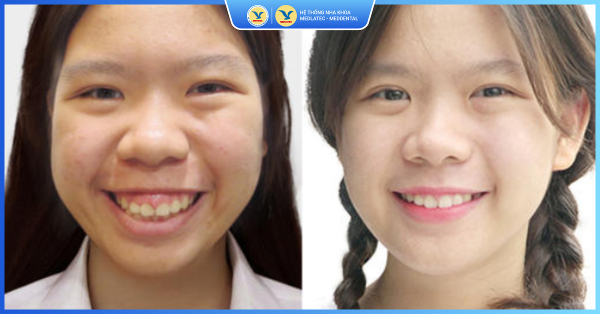 Những trường hợp nào nên phẫu thuật hàm hô, móm - Chỉnh răng hô móm