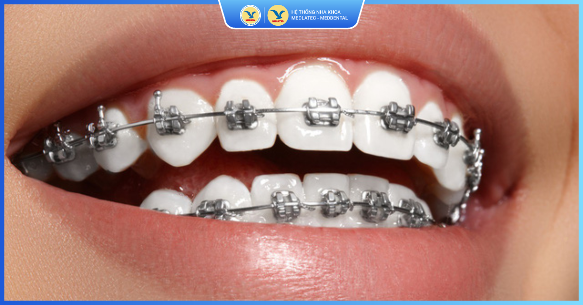 Tìm hiểu tổng quát về phương pháp niềng răng - Niềng răng thẩm mỹ