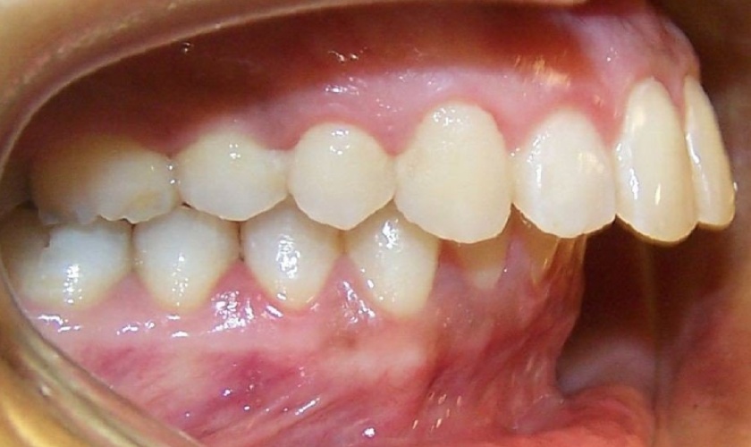 Khớp cắn hô vẩu