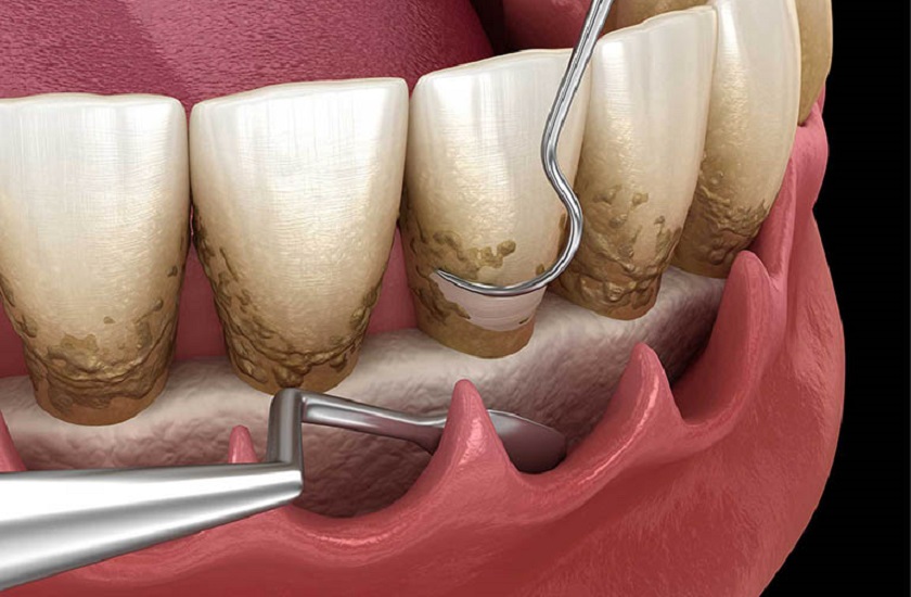 Cạo vôi răng để cải thiện viêm nướu trong trường hợp nhẹ Cạo vôi răng để cải thiện viêm nướu trong trường hợp nhẹ