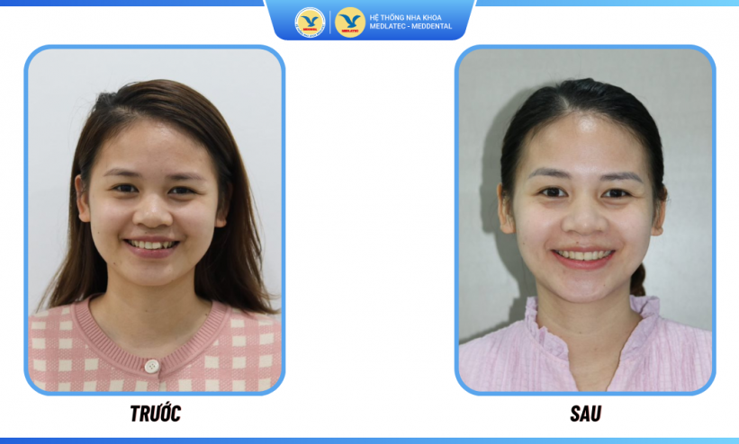 Phản hồi của khách hàng Kim Huyền về dịch vụ Niềng răng invisalign tại MedDental