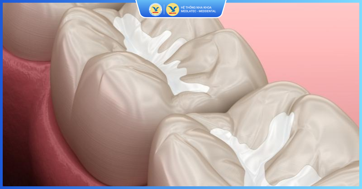 Vật liệu Composite - Hàn răng