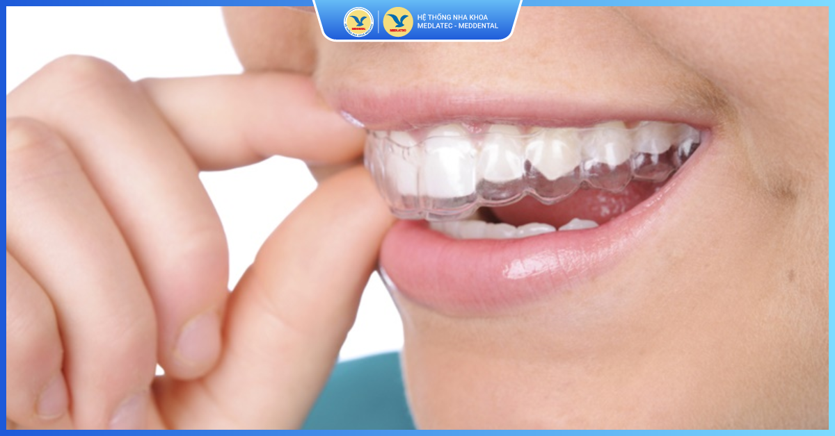 Tẩy trắng răng tại nhà - Tẩy trắng răng
