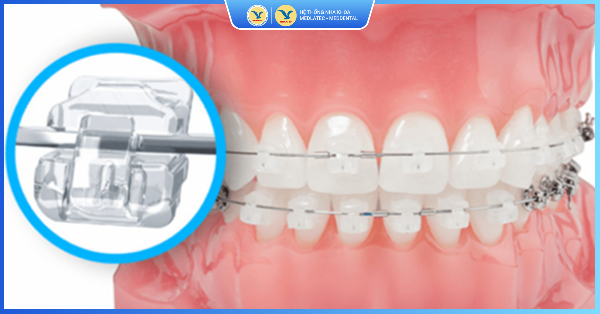 Hiệu quả chỉnh nha cao - Niềng răng mắc cài pha lê