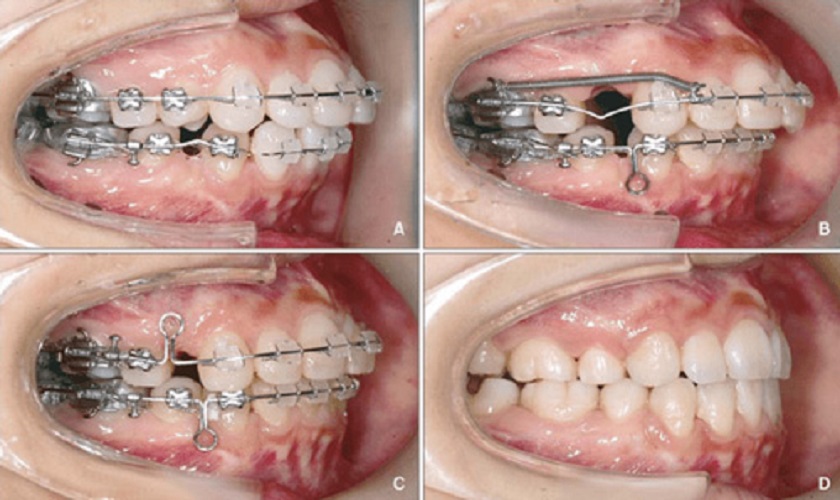 Biện pháp chỉnh nha kéo răng ngầm Biện pháp chỉnh nha kéo răng ngầm