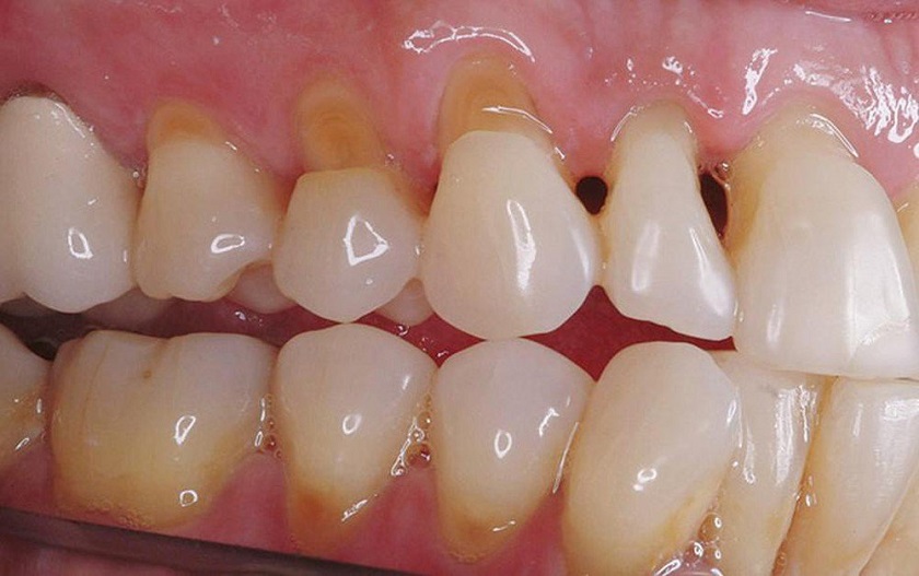Mòn cổ chân răng là bệnh lý gì
