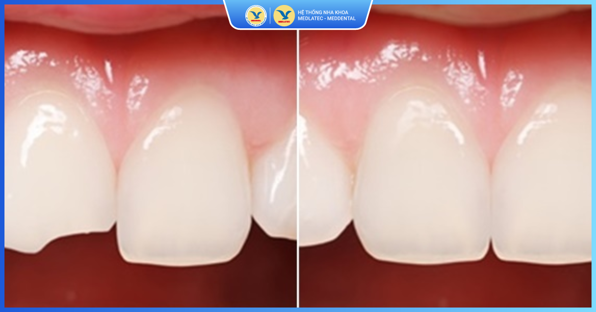 Ưu điểm khi hàn răng - Trám răng thẩm mỹ