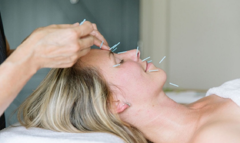 Châm cứu điều trị lệch mặt do tê liệt thần kinh