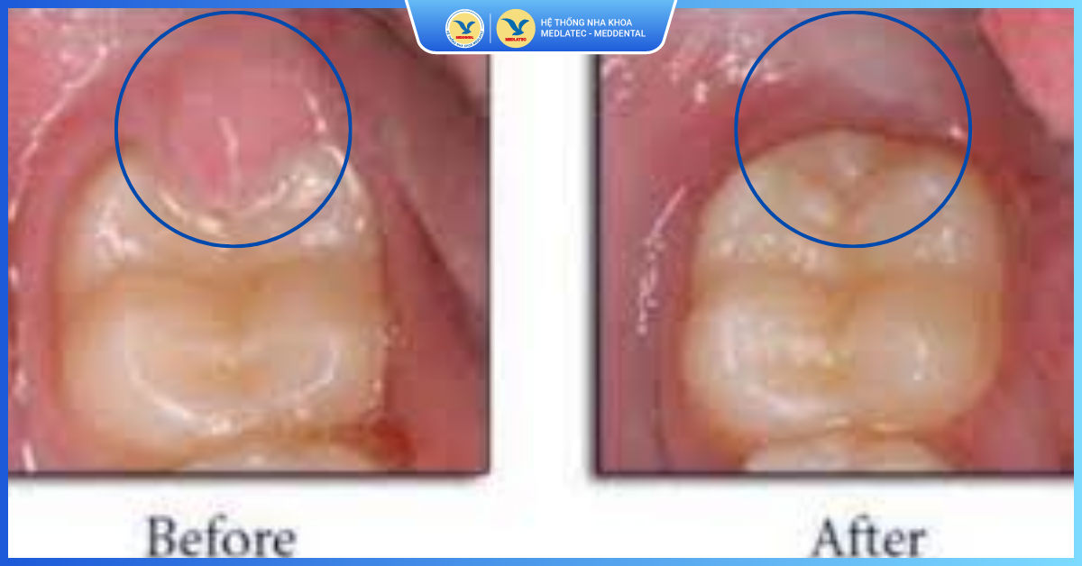Cắt lợi trùm bao lâu thì khỏi - Cắt lợi trùm