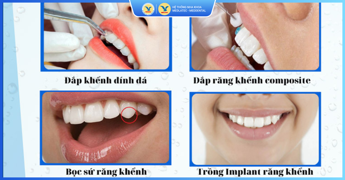 Trám răng khểnh là như thế nào? - Trám răng khểnh