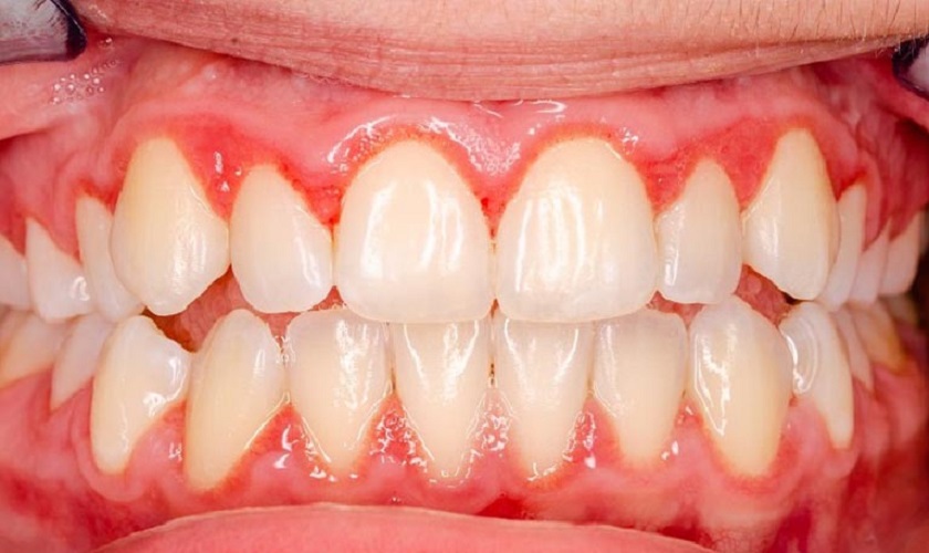 Bệnh lý viêm lợi với biểu hiện ửng đỏ và sưng tấy Bệnh lý viêm lợi với biểu hiện ửng đỏ và sưng tấy