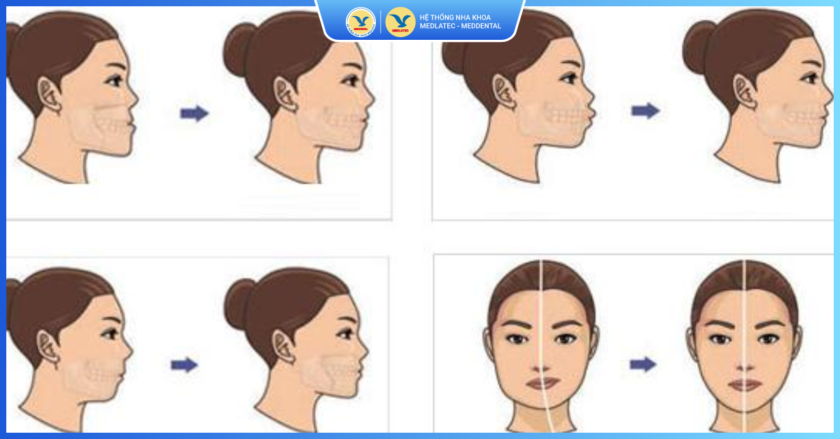 Lợi ích - Chỉnh răng hô móm