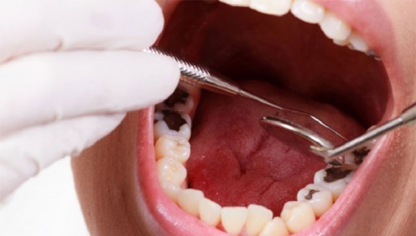 Điều trị nhức răng do sâu răng