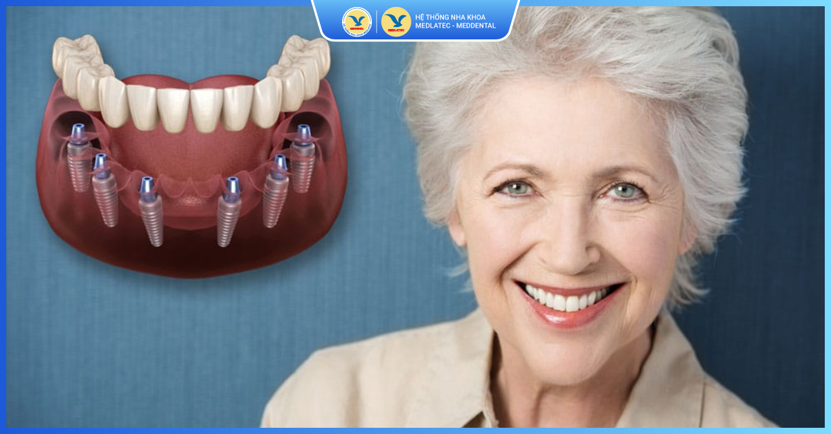 Có thể trồng răng Implant cho người già không? - Trồng răng Implant
