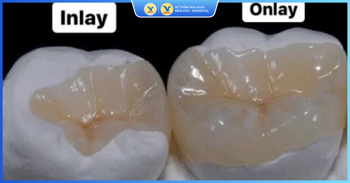 Hàn răng bằng sứ Inlay – Onlay - Hàn răng