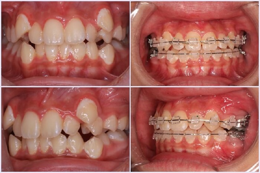 Niềng răng bị lồi xỉ Niềng răng bị lồi xỉ