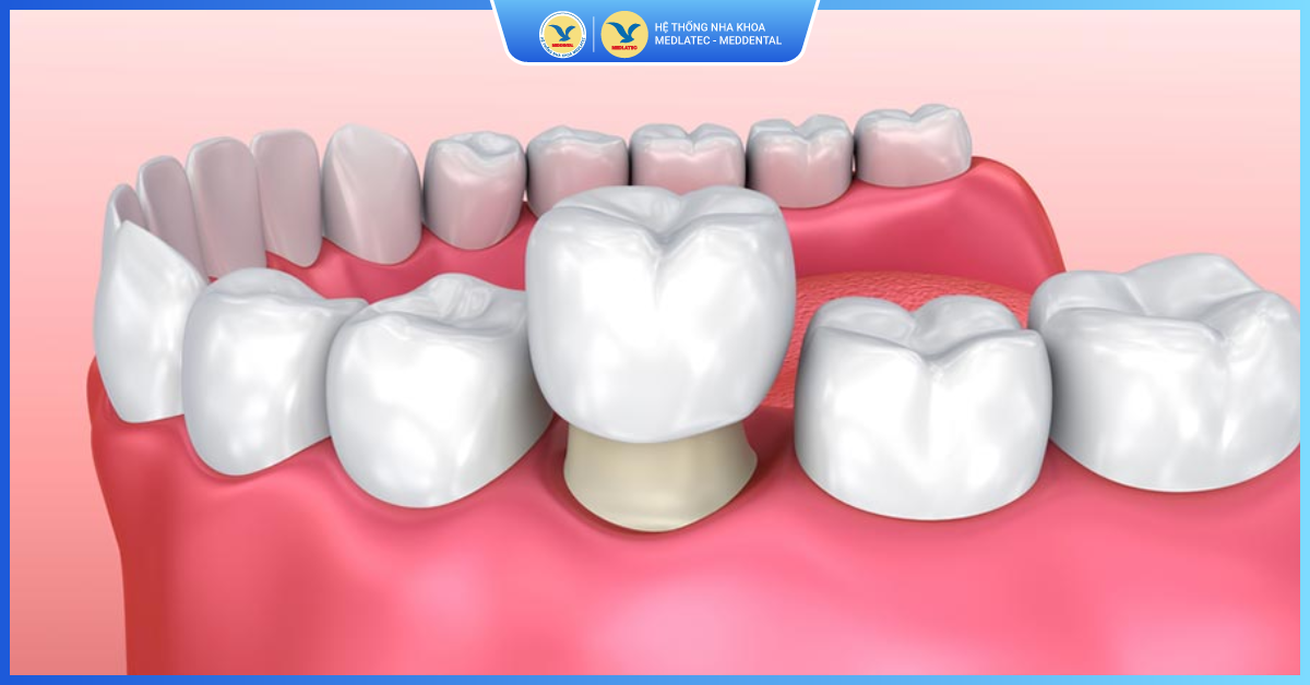Bọc răng sứ là gì? - Bọc răng sứ thẩm mỹ