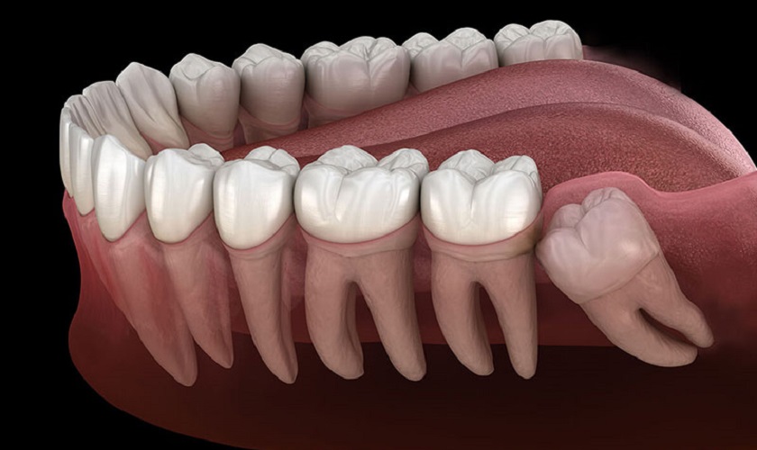 Nên nhổ răng khôn khi chúng mọc bất thường Nên nhổ răng khôn khi chúng mọc bất thường