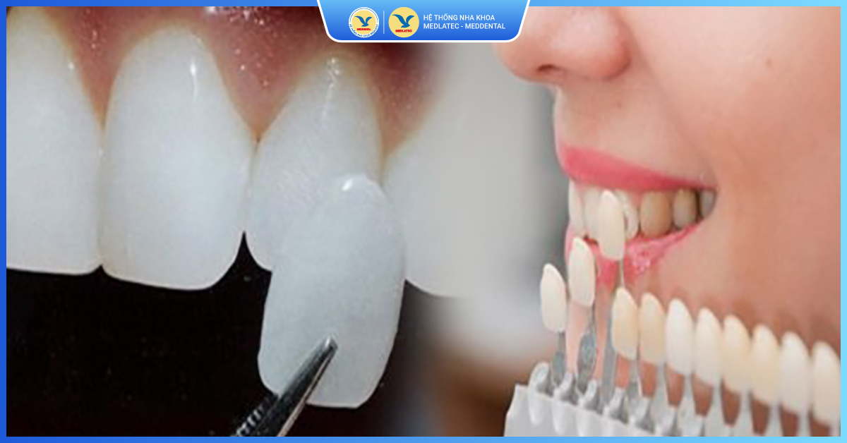 Có thể dùng mặt dán sứ Veneer Ultrathin trong trường hợp nào? - Dán sứ Veneer