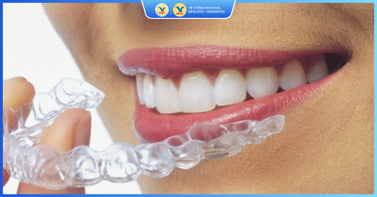 Niềng răng khay trong - Niềng răng thẩm mỹ
