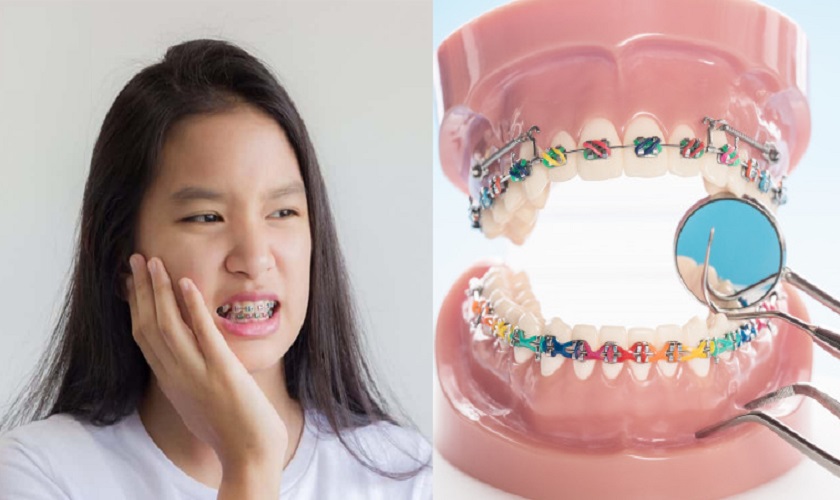 Niềng răng khi khách hàng bị đau quai hàm gần tai do sai lệch khớp cắn