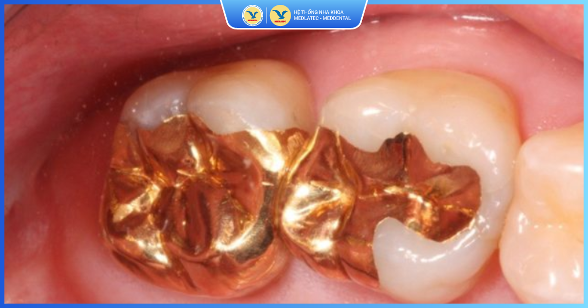 Hàn răng bằng kim loại quý - Hàn răng