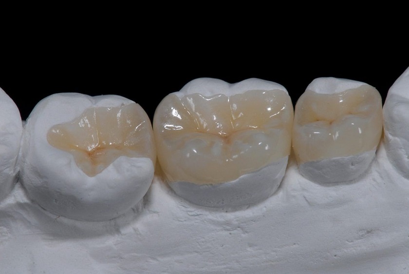 Trám răng hiệu quả khi bị nứt răng nhẹ Trám răng hiệu quả khi bị nứt răng nhẹ