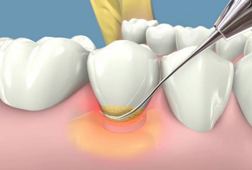 Nguyên nhân mòn cổ chân răng phổ biến