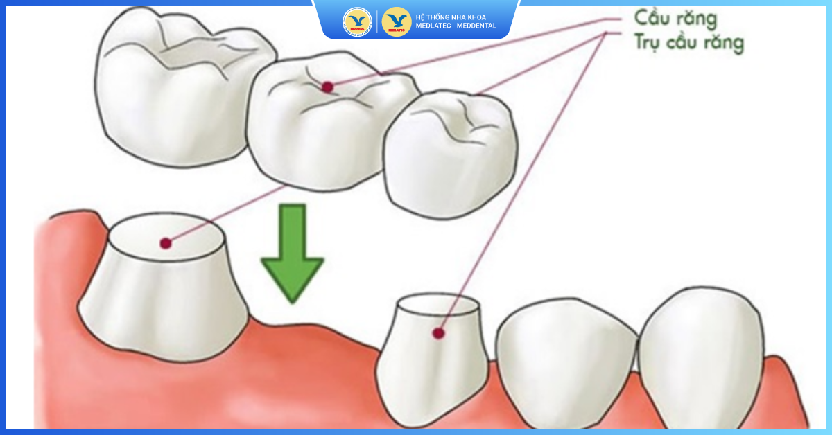Làm cầu răng sứ có bền không? Sử dụng được bao lâu? - Cầu răng sứ