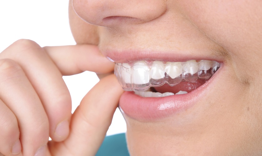 Tẩy trắng răng tại nhà với máng tẩy